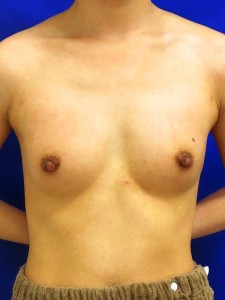 ①術後1ヶ月　正面